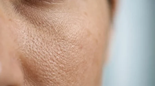 Peau en cours de traitement par peeling médical montrant les différentes couches cutanées